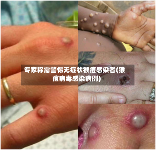专家称需警惕无症状猴痘感染者(猴痘病毒感染病例)-第3张图片